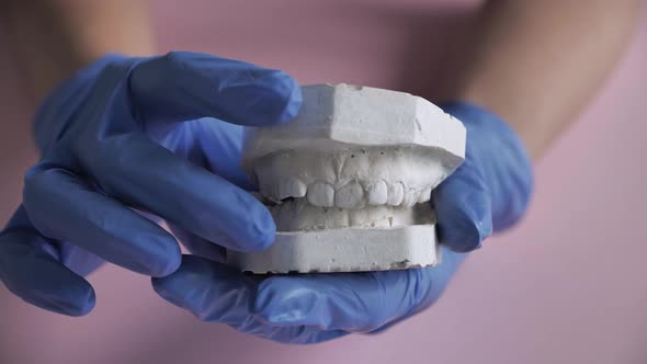 Gypsum Model of the Teeth Before Installing the Bracket System alt