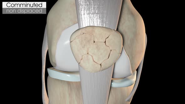 Patella Fracture   Comminuted Non Displaced alt