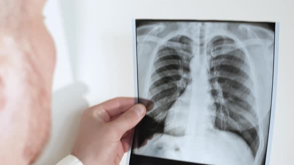 Radiologist   A Specialist Analyzes An X Ray Of A Person's Lungs On A White Background. Pneumonia