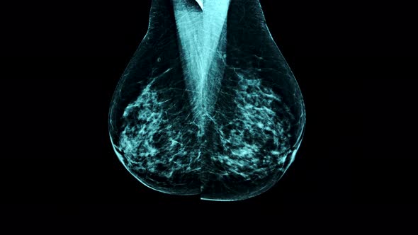 Close up of Mammogram X-Ray Analysis