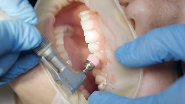 Cleaning Teeth From Plaque