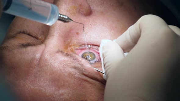 Surgeon is Anaesthetizing Patient's Eye During Operation alt