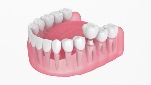 Jaw with dental crown embed on reshaped tooth over white background