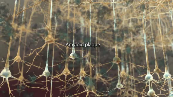 Amyloid Plaques. The beta-amyloid protein involved in Alzheimer's disease alt