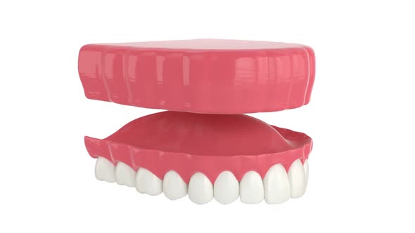 Removable traditional denture installation