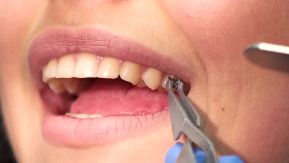 Mouth of Woman and Bracket. alt