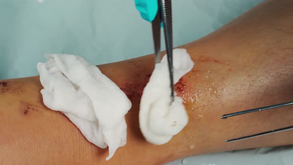 close up doctor cleaning wound on the leg by alcohol, Injuries from falling