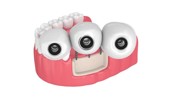 Dental bridge supported by mini dental implants over white background