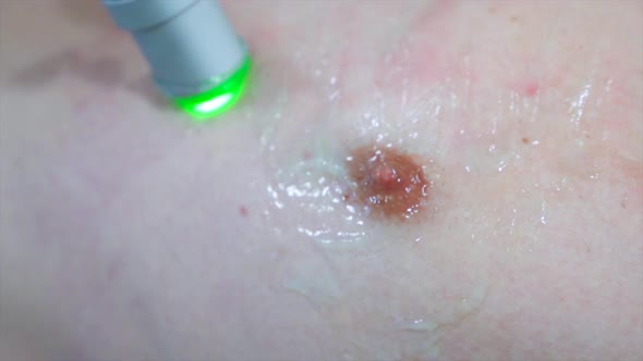 Close up nipple depilation laser hair removal procedure treatment alt