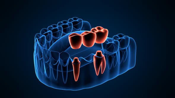 Jaw with dental bridge supported by molar and premolar teeth on dark blue background