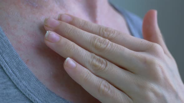 A Little Ointment is Taken From a Tube of Ointment and Applied to the Skin Inflammation with Small alt