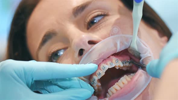Dentist Install Arc On Braces