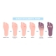 Diabetic Foot 