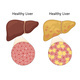 Healthy and Fatty Liver Disease Medical Science