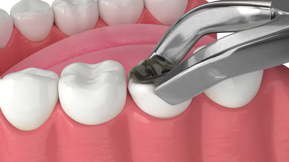 3d dental bone grafting and bone augmentation procedure