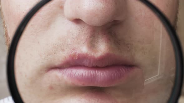 Pimple On The Lip. Viral Herpes In Humans. A Young Man Demonstrates The Viral Disease Herpes.