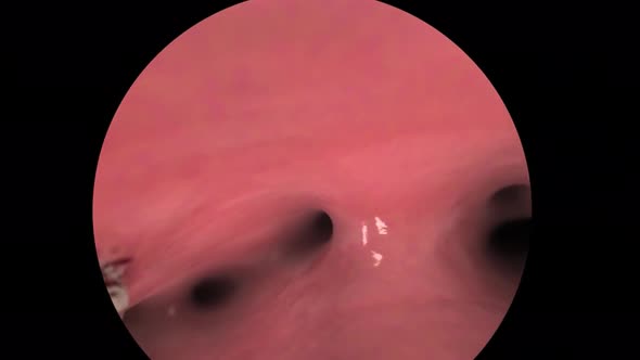 Medical doctor verifying the state of the lungs using bronchoscope and fluorescent image. alt