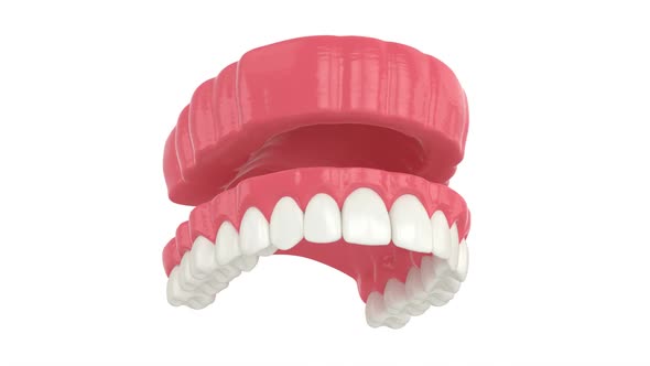 Removable traditional denture installation