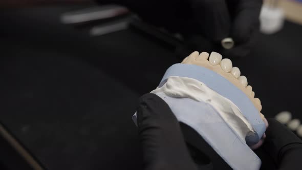 Installation of Veneers on the Jaw alt