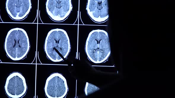 Medical scientist with a pen points at CT, MRI brain scan images on a big screen. 