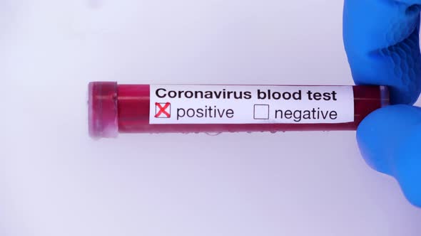 Coronavirus outbreak and blood test concept in medical laboratory