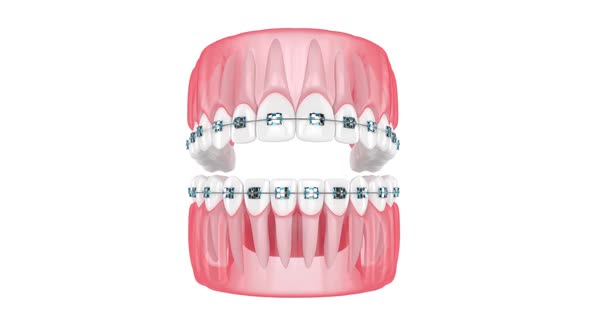 Jaw with teeth and stainless steel orthodontic braces  isolated over white background