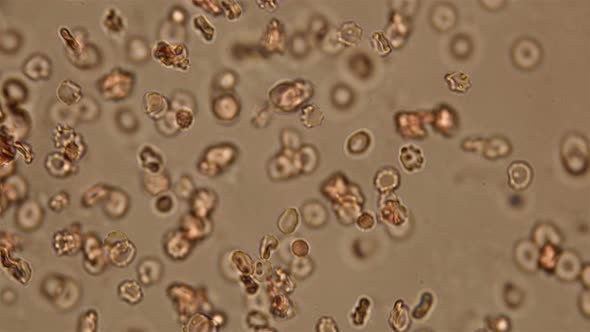 Blood Under a Microscope, the Movement of Dead and Damaged Cells in Human Blood That Have Lost Their alt