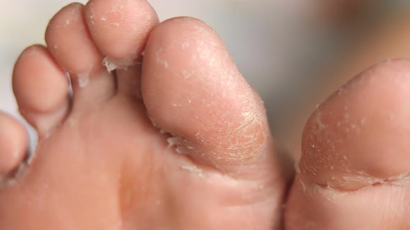 Female Feet During an Acid Peeling Procedure