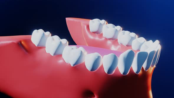 Tooth Medical Dental Implant Process, Motion Graphics | VideoHive