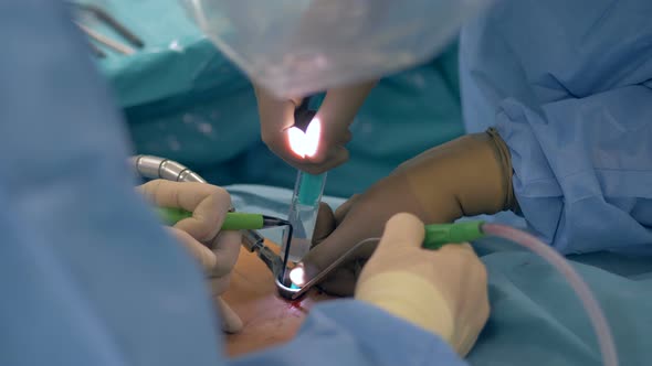 Close Up of a Surgical Process Implemented Through a Puncture alt