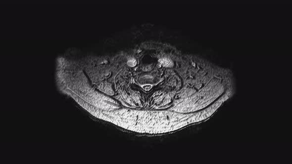 Postoperative Voluminous MRI of Female Organs for the Detection of Metastases alt