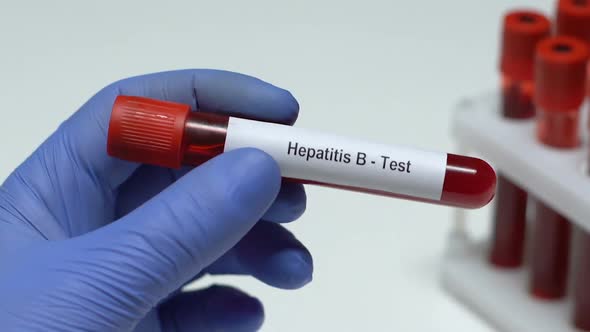 Hepatitis B-Test, Doctor Holding Blood Sample in Tube Close-Up, Health Check-Up alt