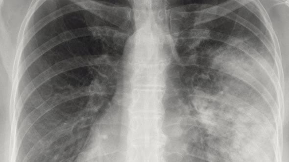 X-ray of the lungs with pneumonia