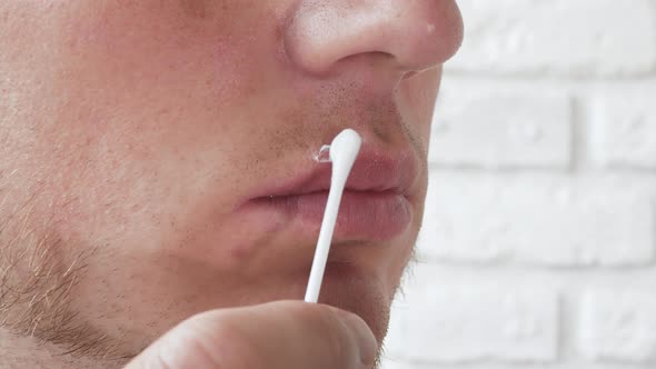 Herpes On The Lip Of A Young Man, On A Cotton Swab