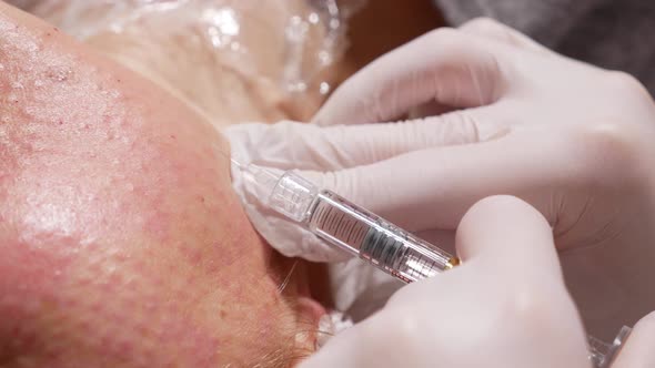 Doctor Beautician Pricks the Patient's Face alt