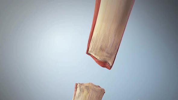 Tendon rupture is a long partial or complete tear of the tendon. alt