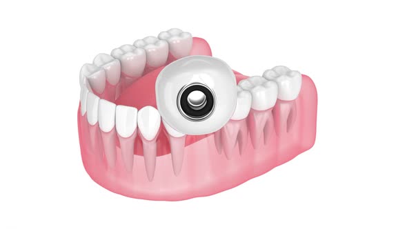 Mini dental implant placement over white background