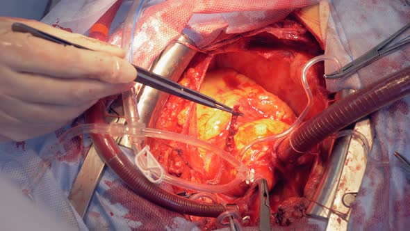 A Surgeon Holds Metal Forceps While Operating on an Open Heart alt