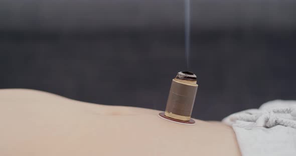 Woman undergo moxibustion therapy on her body alt