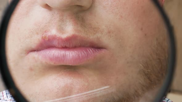 Pimple On The Lip. Viral Herpes In A Person On The Lip