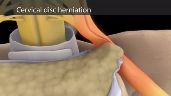 Numbness of the middle finger as a result of nerve compression alt
