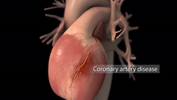 Carotid Artery Disease 3D Medical Animation alt