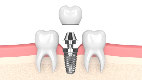 Dental implant placement  over white background