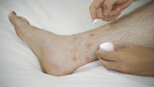 Dyshidrotic Eczema on the Foot Dermatitis