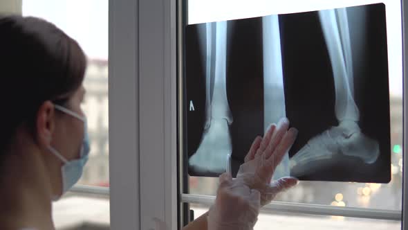 Doctor Examines Xray Film of Broken Leg alt