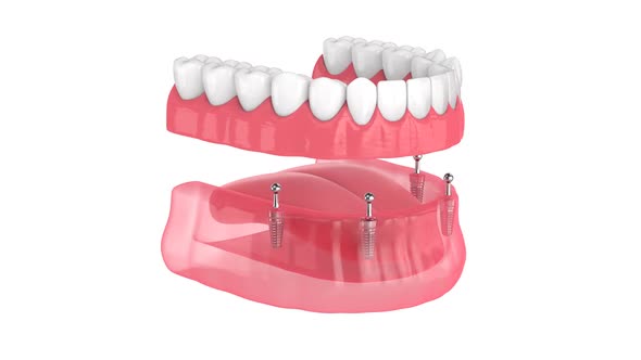 All-on-4 removable, implants supported, overdenture installation alt
