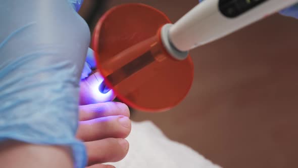 Podologist treatment a titanium thread on the big toe and using UV gadget alt