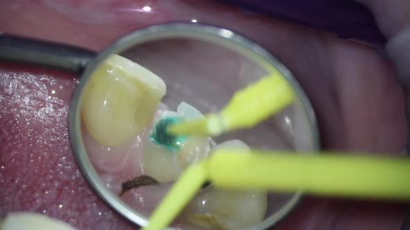 dentistry. video filming under a microscope. applying caries marker on a diseased tooth. Dental brew