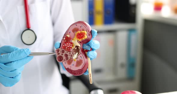 Nephrologist Holding Model Of Human Kidney In Clinic By Kuprevich 