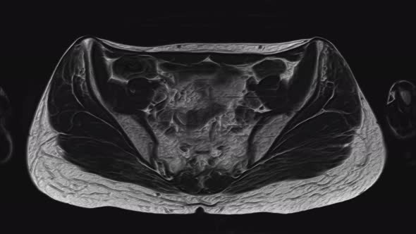 Voluminous MRI of the Female Pelvic Organs, Abdominal Cavity, Gastrointestinal Tract and Bladder alt